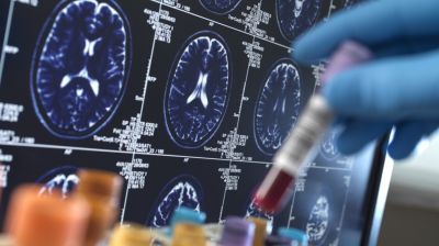 Alzheimer-kór: óriási lépést tettek kutatók a megelőzés felé