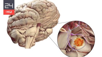 Tíz évet is elvehet az ember életéből ez a betegség